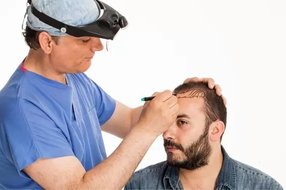 Haartransplantation